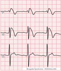 Figure 1 courtesy of ECGpedia.org.