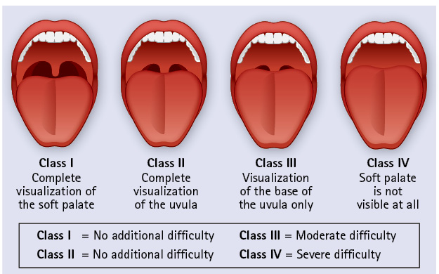 Figure 1. The Mallampati Score