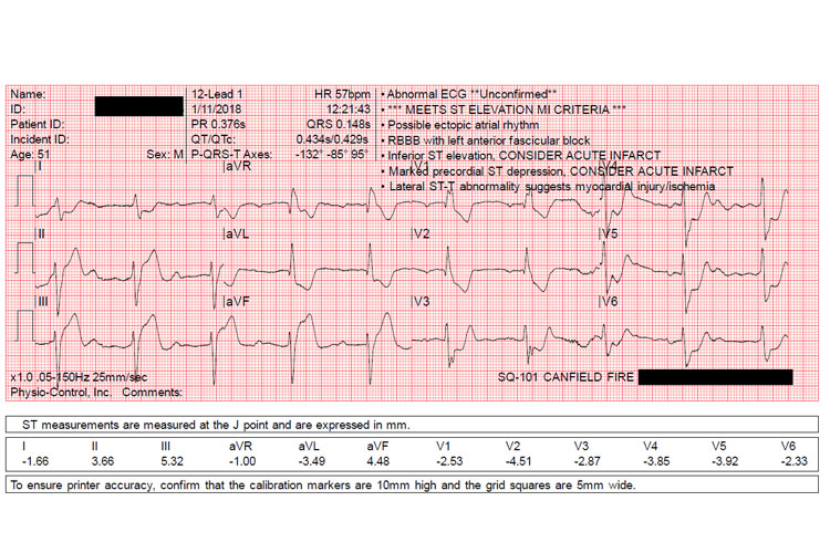 EKG figure