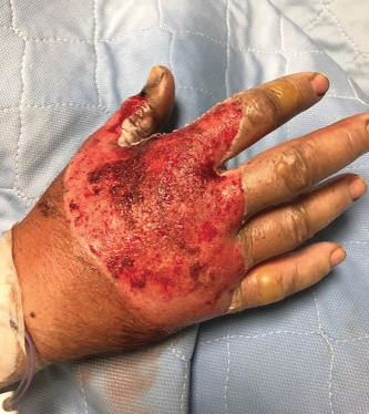 Full thickness third-degree burns to the right hand after debridement, day 2. 