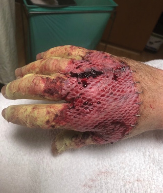 Right hand postgraft, day 9.