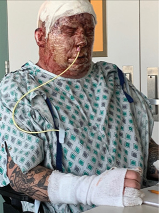 Zeigler several days after being admitted to the University Medical Center with severe burns covering more than 30% of his body.