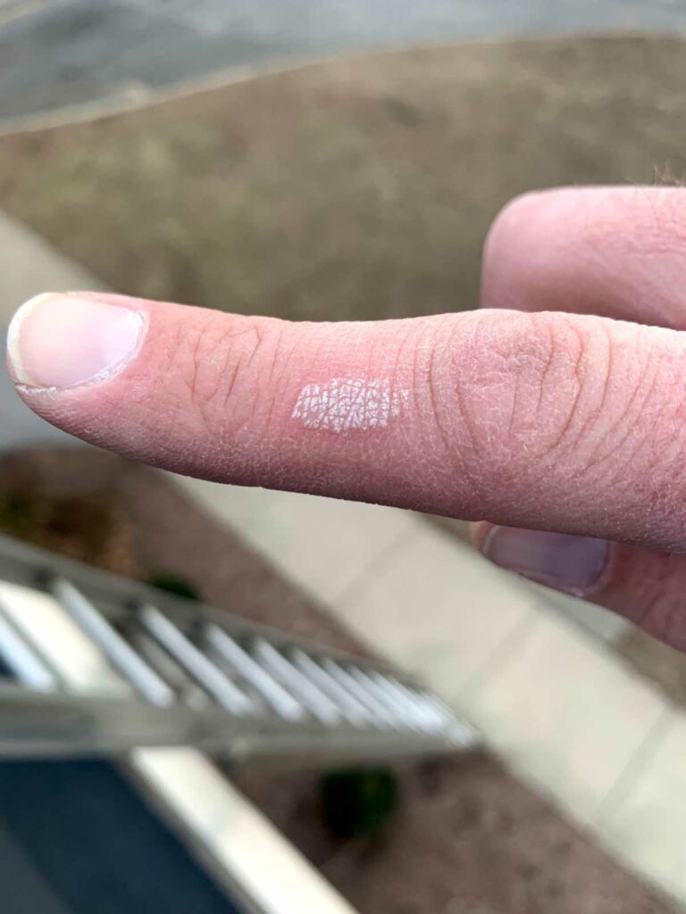 Finger after coming in contact with heat exchanger