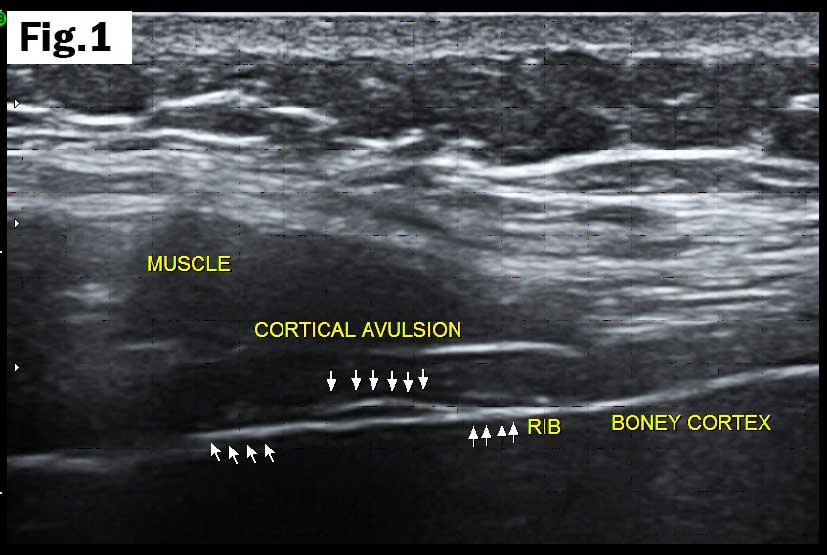 Rib cortical avulsion