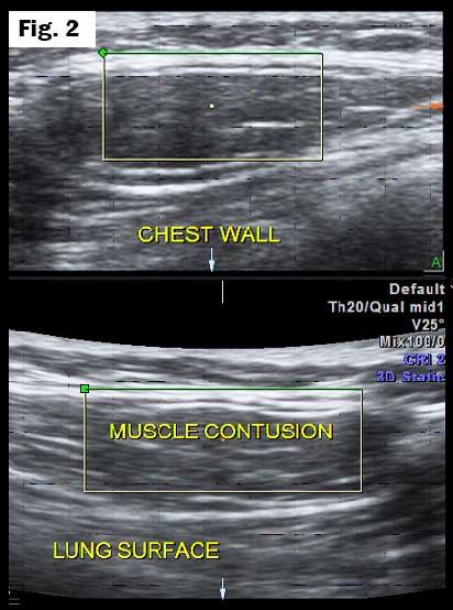 Chestwall contusion