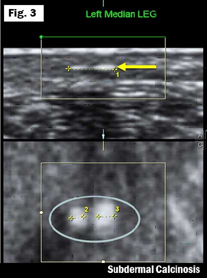 White dots of heavy metal poisoning in dermis